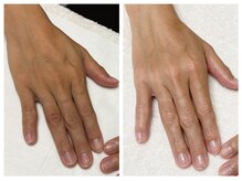 キレイテ 福岡天神店/年齢による手のシワのお悩み