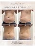 当店オススメ【先着30名】"引き締め"脂肪分解 <近赤マシンx高濃度ヒト幹細胞>