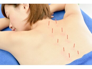 くじら整体院 鍼灸院の写真/やさしい鍼灸で慢性的な不調改善&美容鍼でエイジングケア☆
