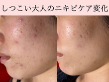 サロン ド エン(Salon de. en)の雰囲気（ニキビケア×ハーブピーリングで【ハーブピーリング/金山】）