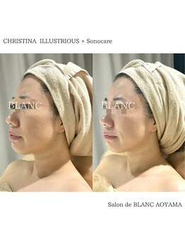 サロン ド ブラン アオヤマ(Salon de BLANC AOYAMA)/美白ケア&小顔ケア