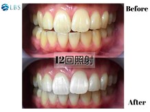 LBSホワイトニング 吉祥寺店/ホワイトニングビフォーアフター