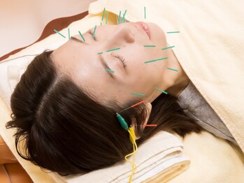 三越前はり灸整骨院/眼精疲労の鍼施術