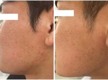 ホワイトアクア 岐阜店(WHITE AQUA)/ハーブピーリング/岐阜/ニキビ