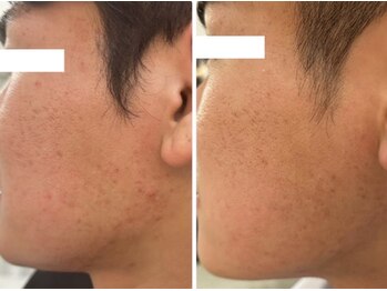 ホワイトアクア 岐阜店(WHITE AQUA)/ハーブピーリング/岐阜/ニキビ