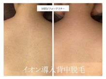 リノ(Lino)/背中脱毛シェービング付き♪