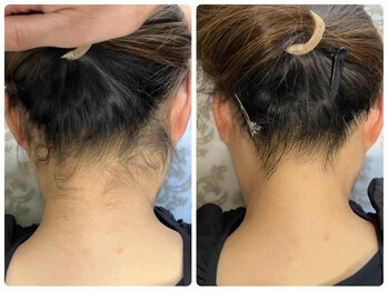 アプロディタ/うなじ脱毛で後ろ姿美人♪