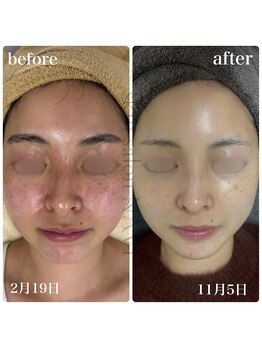 ナビ(NAVI)/シミ、くすみ、赤み