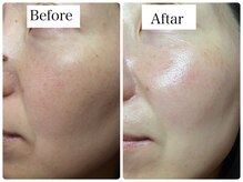 リラビューティー(Lilas Beauty)/幹細胞100%！驚異的な美白力！