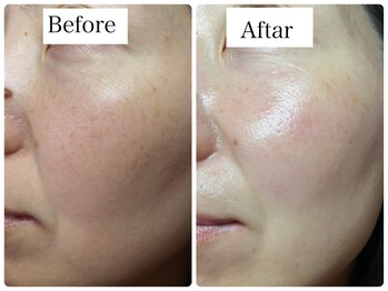 リラビューティー(Lilas Beauty)/幹細胞100%!驚異的な美白力!