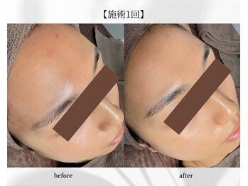 アン ビューティー(ann beauty)/施術1回【症例写真】30代