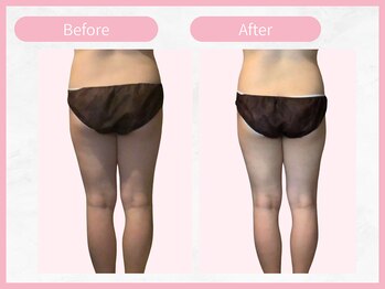 RHB 横浜店/【痩身コース】ビフォーアフター