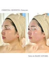 サロン ド ブラン アオヤマ(Salon de BLANC AOYAMA)/BIOPHYTO×Sonocare