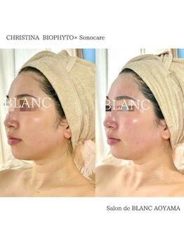 サロン ド ブラン アオヤマ(Salon de BLANC AOYAMA)/BIOPHYTO×Sonocare