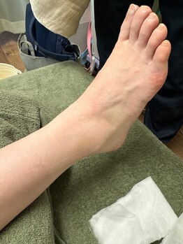 恵比寿ループ鍼灸院(LOOP)/捻挫2回目