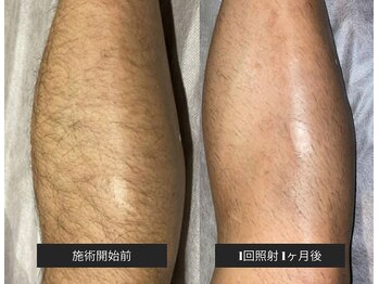 ドシースキンラボ(℃ SKINLAB)/濃い毛もしっかりアプローチ！