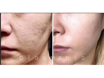 美容整骨小顔ラボ/プラズマ真皮　ビフォーアフター