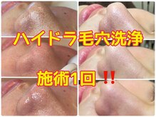ハナン(Hanan)/大人気!ハイドラ毛穴洗浄