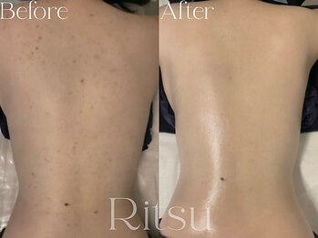 リツ(Ritsu)/背中ピーリング/背中ニキビケア