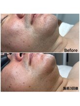 エ リンダ(E- LINDA)/脱毛