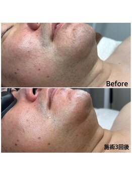 エ リンダ(E- LINDA)/脱毛