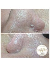 サロン ケイ(Salon K)/毛穴エクストラクション