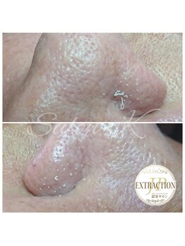 サロン ケイ(Salon K)/毛穴エクストラクション