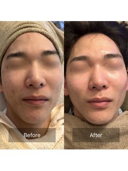 グリーンライツ(GREEN LIGHTS’)/毛穴スッキリコースbefore/after