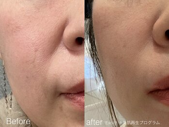 ヒーリア 都島(Healia)/Exolift &nbsp;美肌プログラム