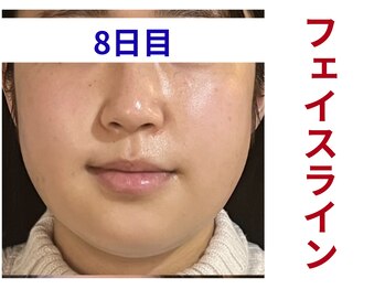 アミュレット 京都(amulette)/【フェイスライン】8日目