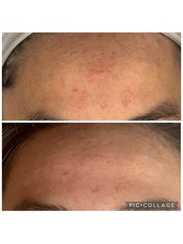 エスポワール/シミ特化型国産ハーブピーリング