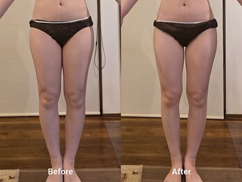 常若(tokowaka)/高周波ケア1回/ビフォーアフター