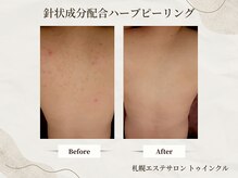 プライベートエステサロン トゥインクル/繰り返す背中ニキビケアに◎