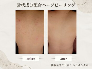 プライベートエステサロン トゥインクル/繰り返す背中ニキビケアに◎