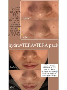 ビジュー(Bijou)/毛穴洗浄TERAボーラーTERAパック