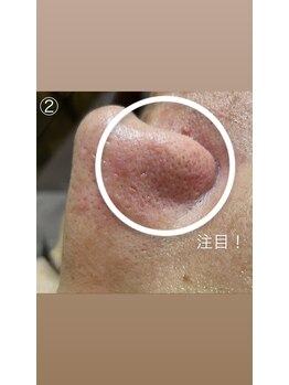 エステサロン桜/黒ずみグッバイ！