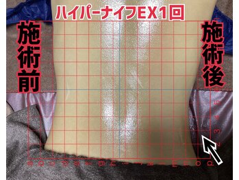 リヘッド(Re.head)/ハイパーナイフEXでくびれ美人