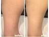 【二の腕ピーリング】¥9000二の腕のざらつき、ブツブツに◎