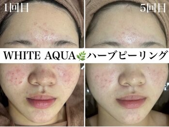 ホワイトアクア 浜松店(WHITE AQUA)/ハーブピーリング/ニキビケア