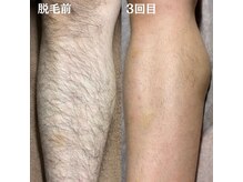 美肌脱毛専門店 パールプラス 大在店/メンズ足脱毛