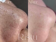 リツ(Ritsu)/黒ずみ/毛穴/毛穴洗浄