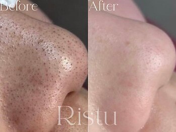 リツ(Ritsu)/黒ずみ/毛穴/毛穴洗浄