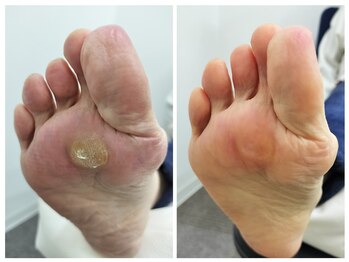 フレッシュフット(FreshFoot)/足のトラブルお任せください