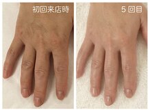 キレイテ 福岡天神店/50代/5回目【大名ハンドケア】