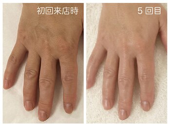 キレイテ 福岡天神店/50代/5回目【大名ハンドケア】