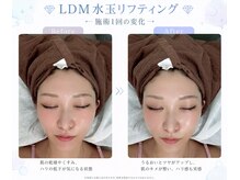 ホワイトニングショップ 町田店/ &nbsp;&nbsp;&nbsp;肌管理しながら小顔ケア♪