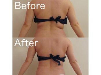 トータルビューティサロン クイーン(Queen)/中々とれない背中のぜい肉