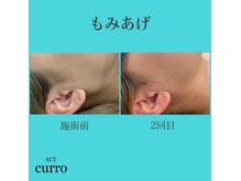 アクト クロ(ACT curro)/【もみあげ】脱毛施術例