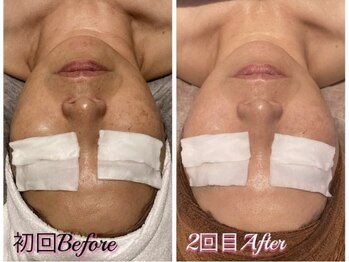 アイラブワン(eye love one)/光フォト【シミ/リフトアップ】