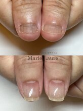 マリーロール 淀屋橋本店(Marie Laure)/自爪育成/深爪矯正/ネイルケア